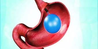 بالون المعدة لإنقاص الوزن من عيادات دكتور فهد ابراهيم